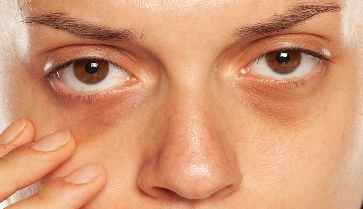 Dark Circles Treatment in Riyadh Fresh, Rested Eyes